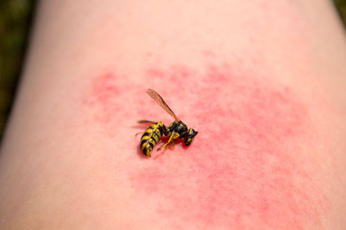 Pflasterpass - Wespe auf einem Arm mit einem Wespenstich